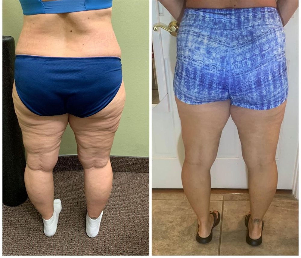 Significant waist slimming and body contouring transformation Creve Coeur MO