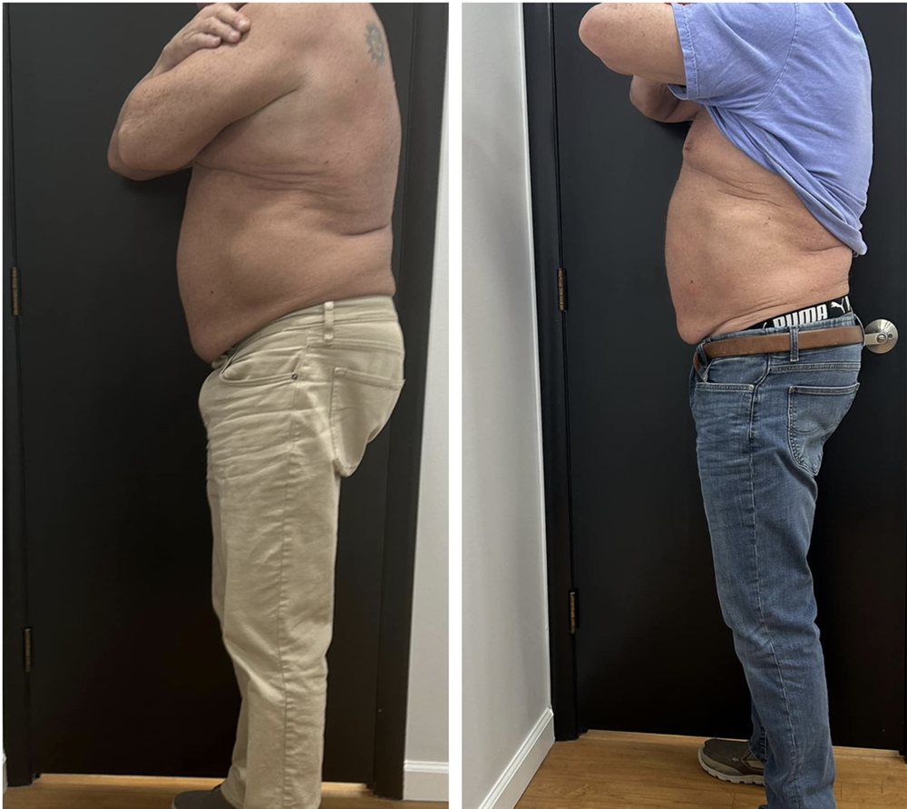 Waist and flank reduction before and after body contouring treatment