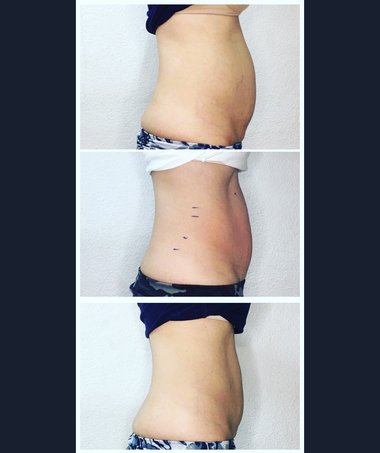 3 SESSIONS CRYO CONTOURING SWYTCH