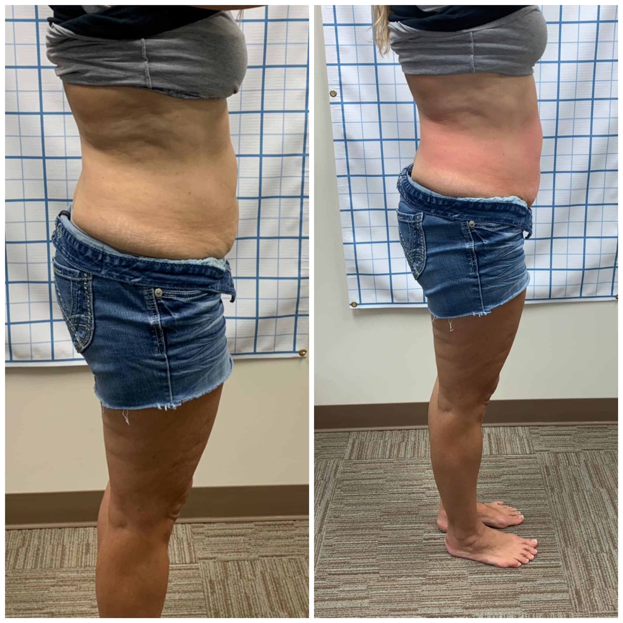 cryo-sculpting-fat-freezing-before-after-woman-11-tummy-right-view