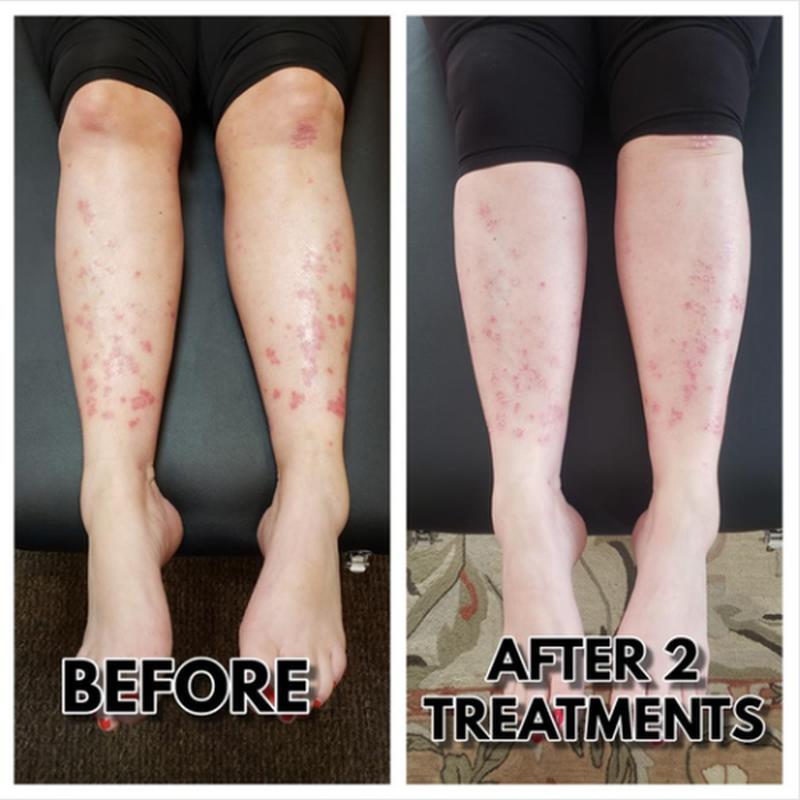 psoriasis-before-after