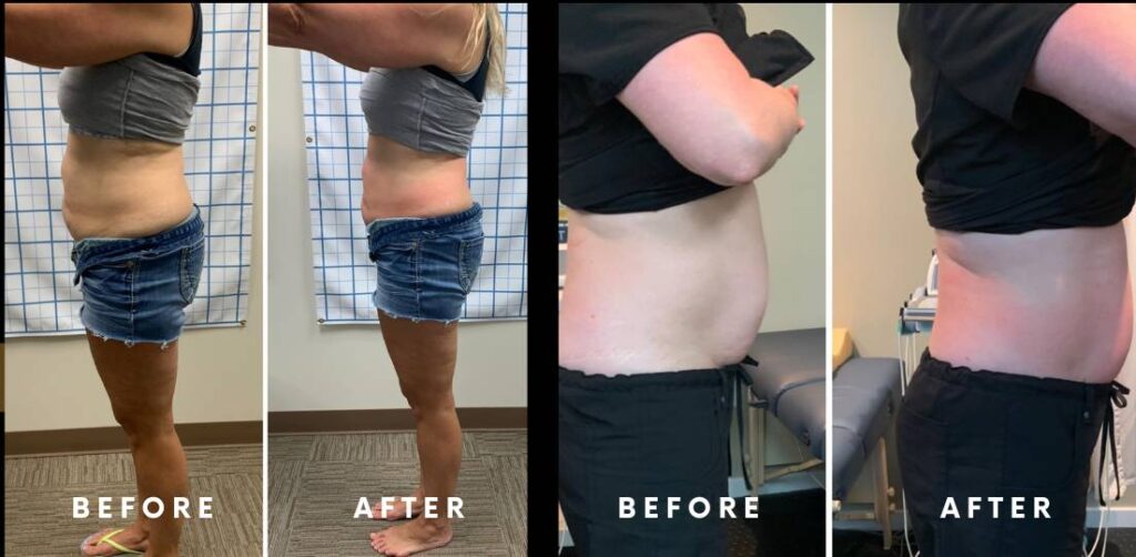 cryo-slimming-bravo-shape