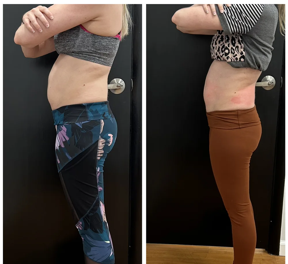 Before and after body contouring on the hip and outer thigh