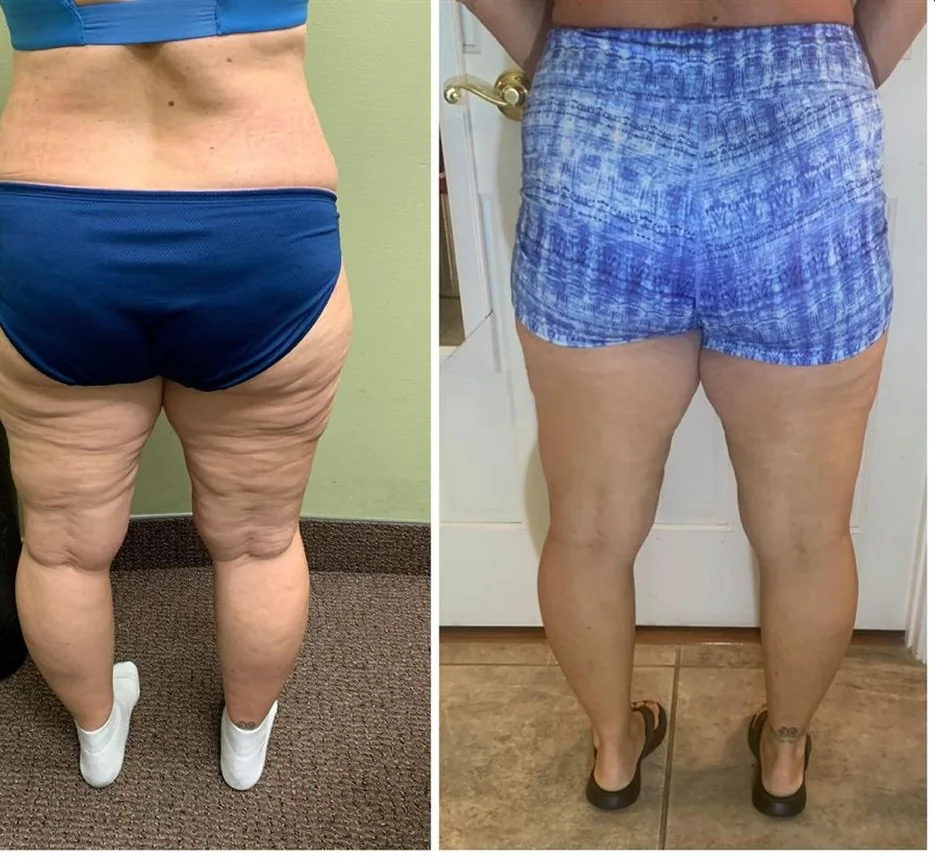 Before and after body contouring on the backs of the legs