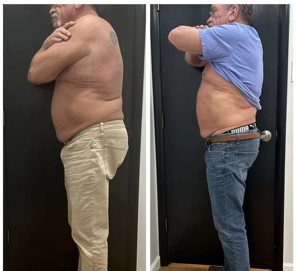 Before and after body contouring on the midsection, close side view