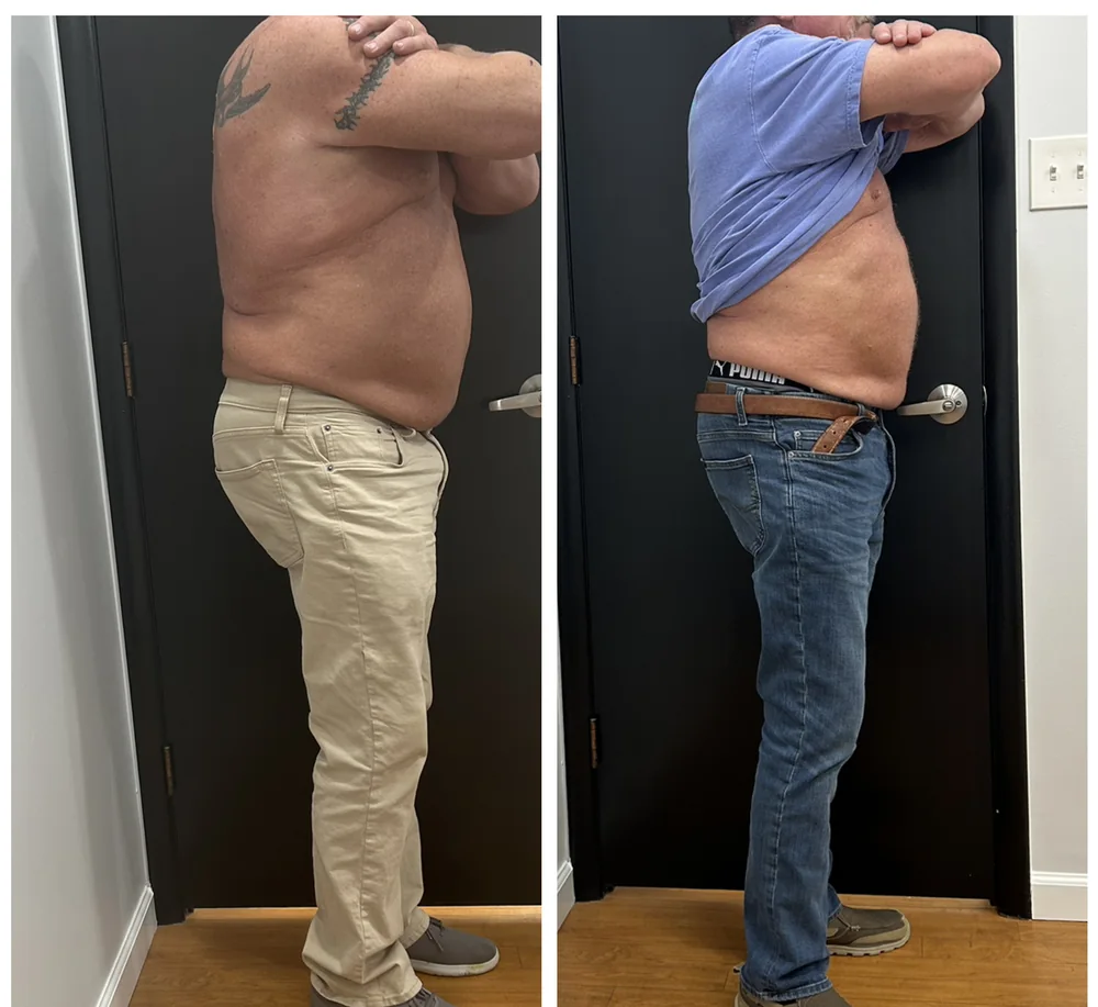 Before and after body contouring on the midsection, standing side view