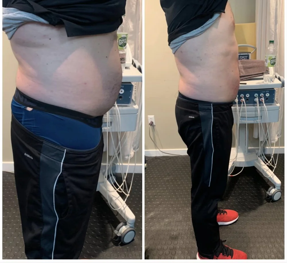 Before and after body contouring on the stomach, side view