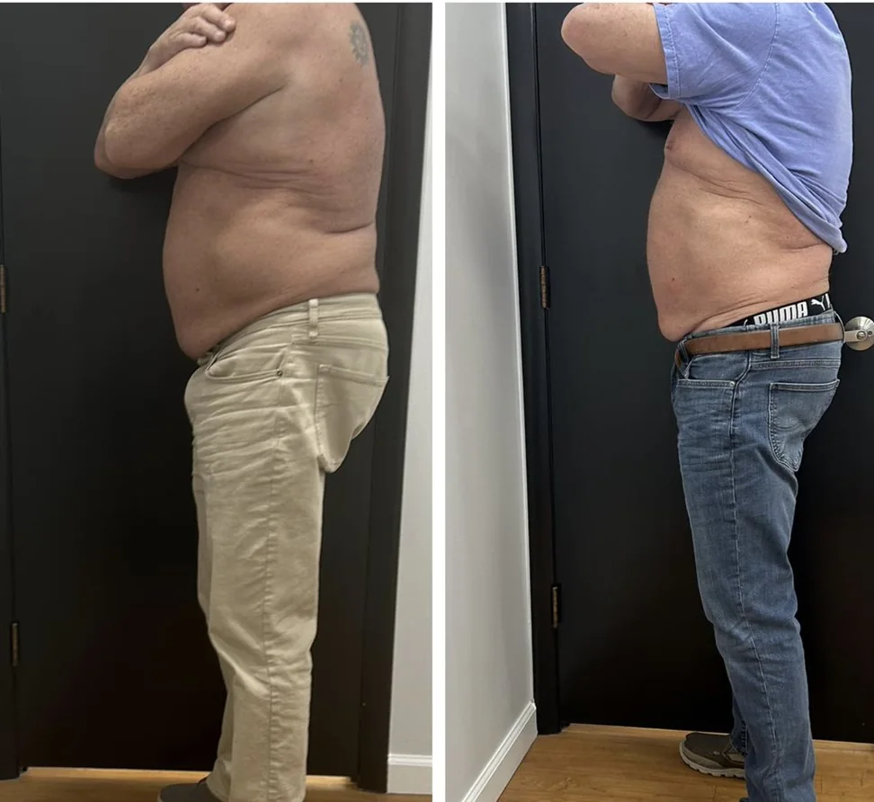 Before and after body contouring on the stomach, side view