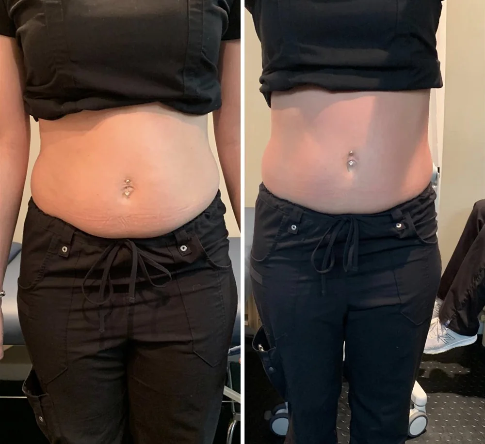 Before and after body contouring on the stomach, front view