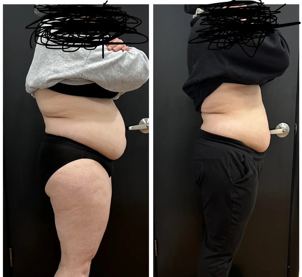 Before and after body contouring on the stomach and hip, side view