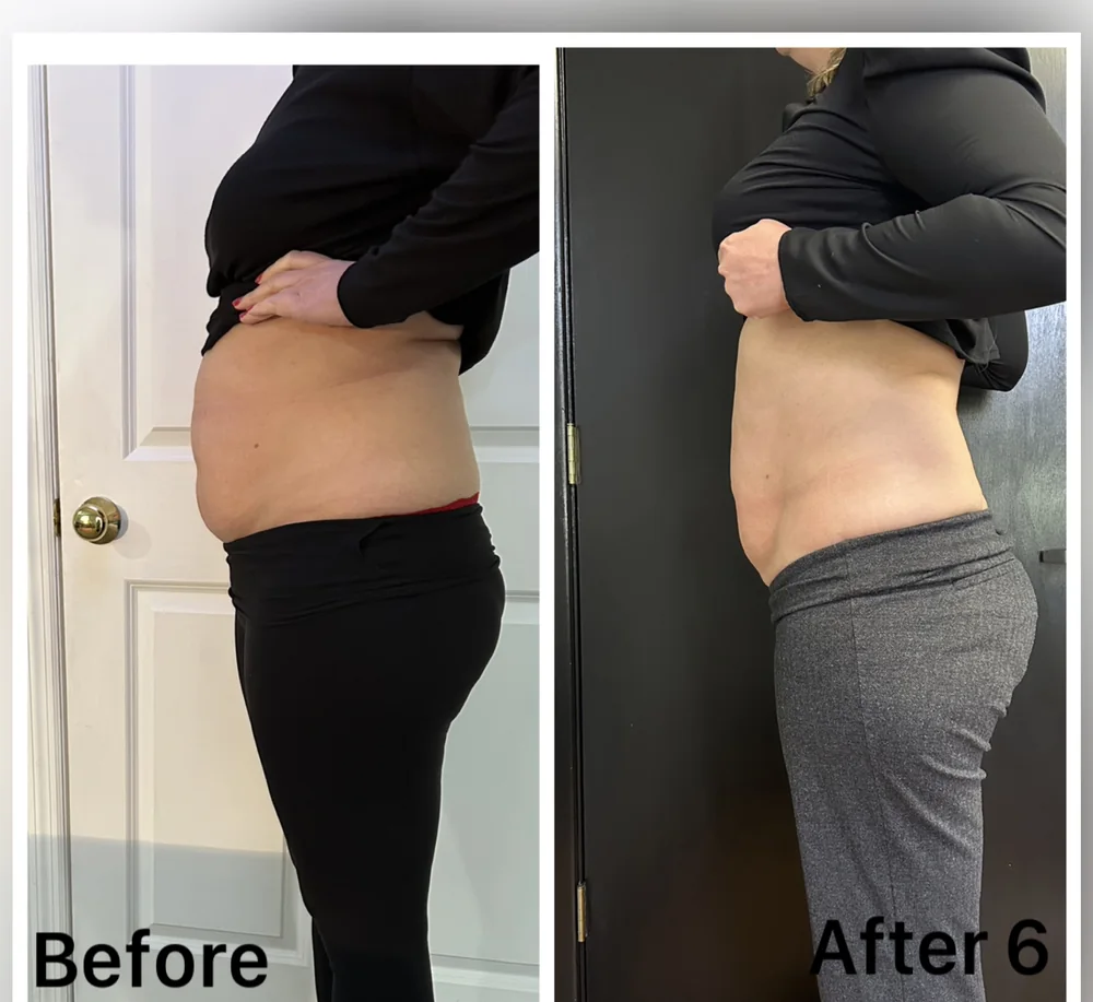 Before and after body contouring on the stomach, side view