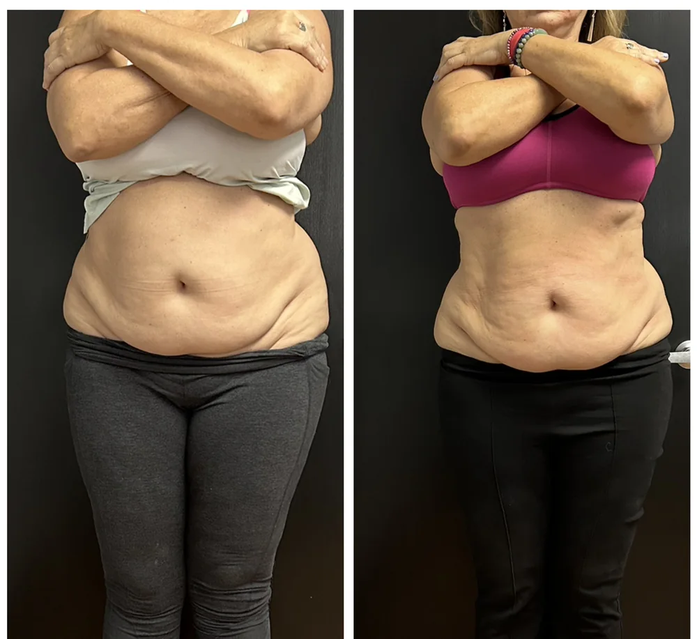 Before and after body contouring on the stomach, seen from the front