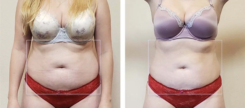 Before and after body contouring on the stomach and waist