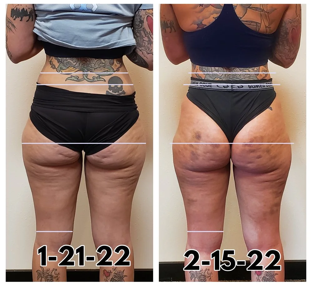 Before and after body contouring on the thighs and back of the legs