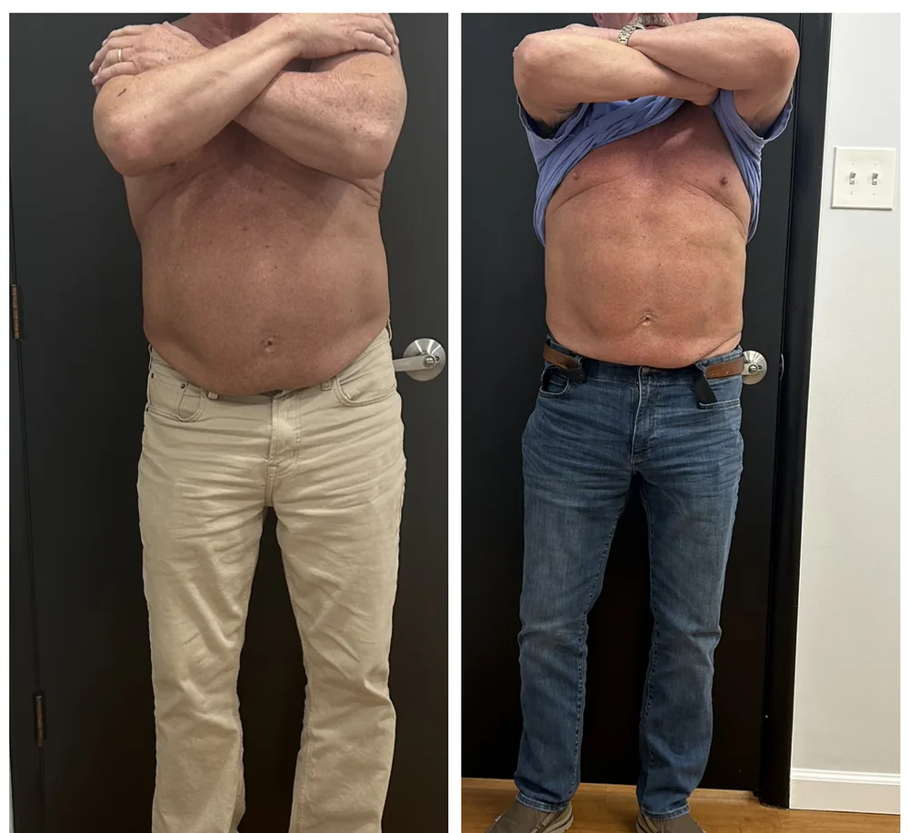 Before and after body contouring on the torso, seen from the front