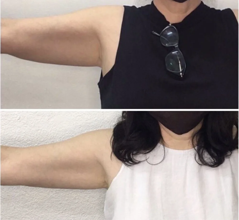 Before and after body contouring on the upper arm