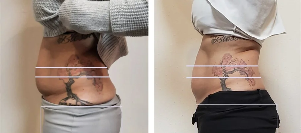 Before and after body contouring on the waist, side view