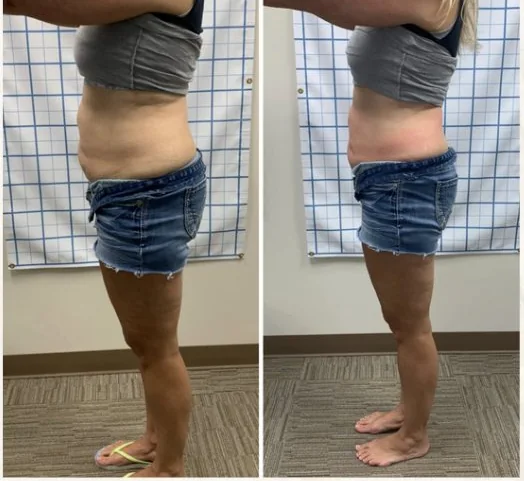 Before and after body contouring on the waist