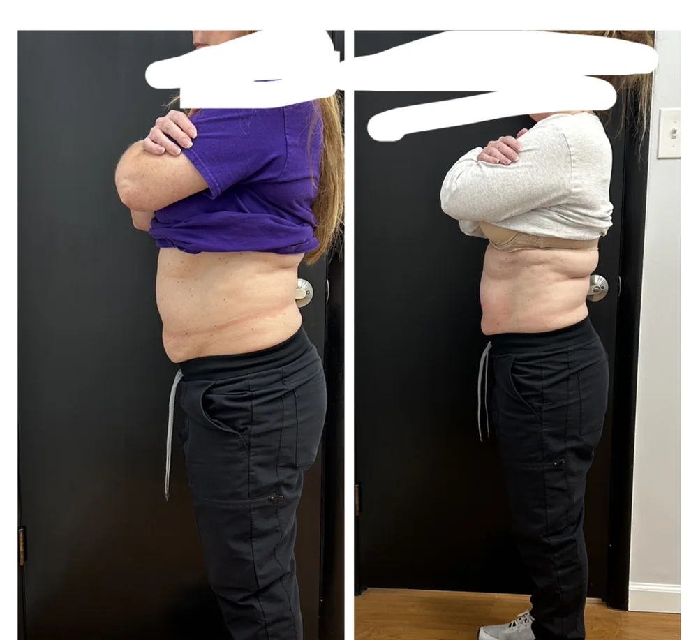 Before and after body contouring on the waist, side view