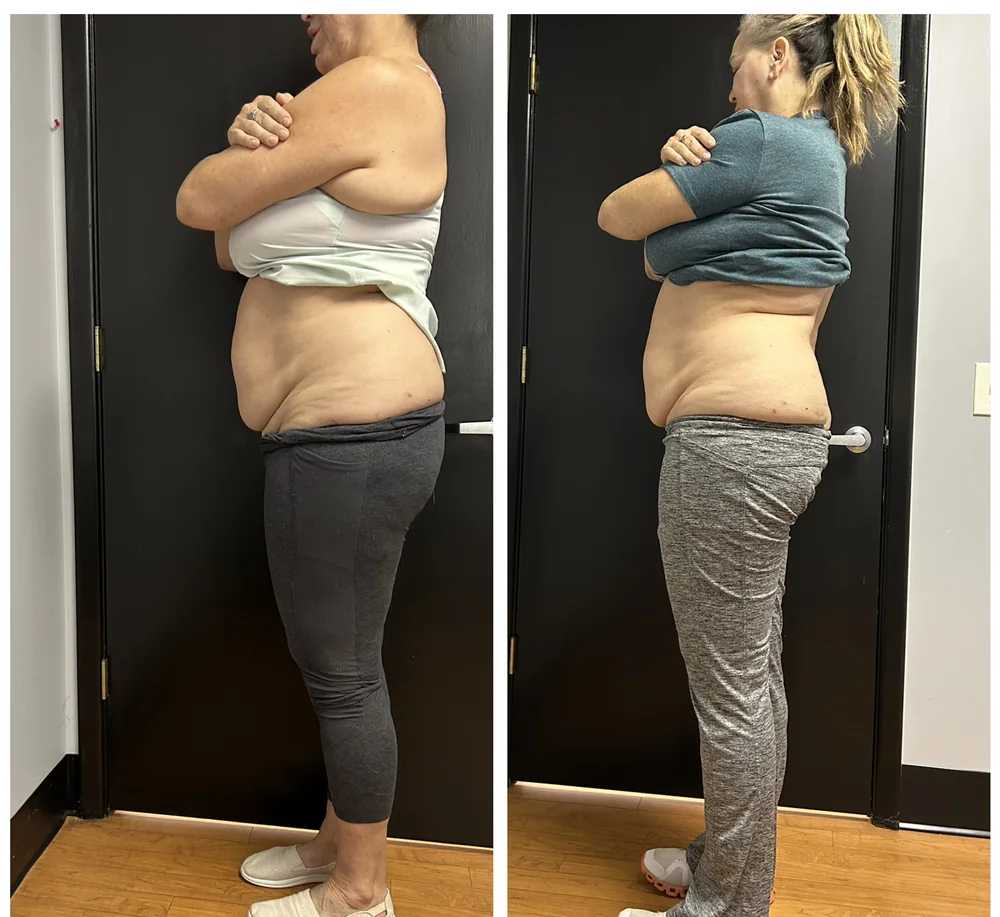Before and after body contouring on the waist and midsection, side view