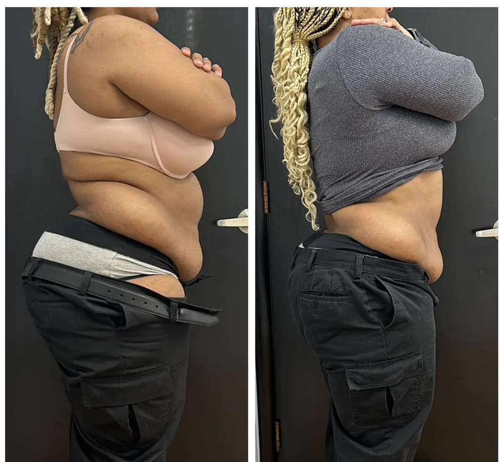 Before and after body contouring on the waist, side view, seen from the back