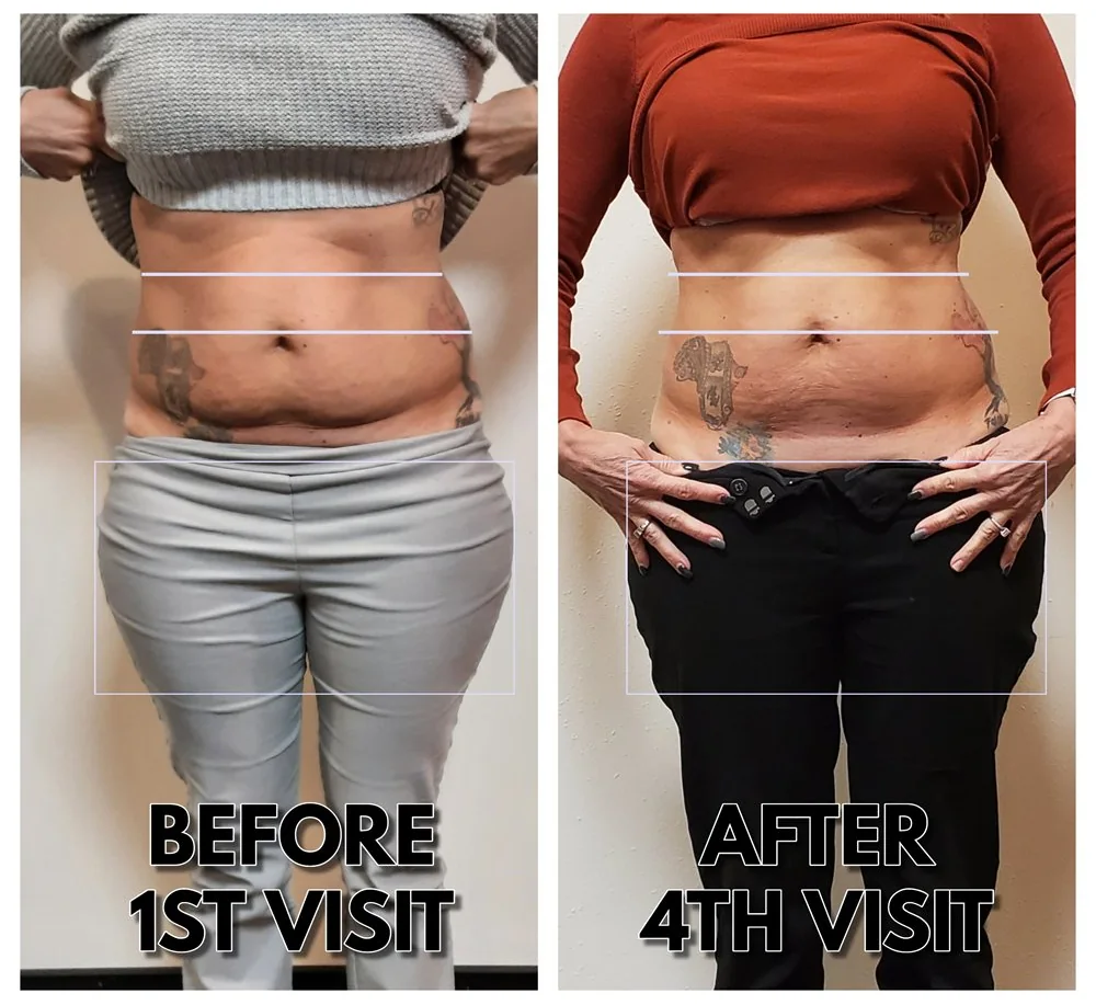 Before and after body contouring on the waist and hips after four visits