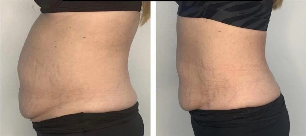 Before and after body contouring on the waistline