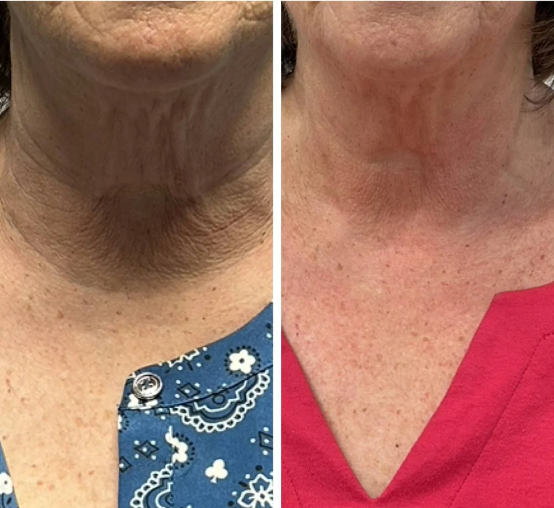 Before and after a course of CryoFacial treatments on the neck and jawline