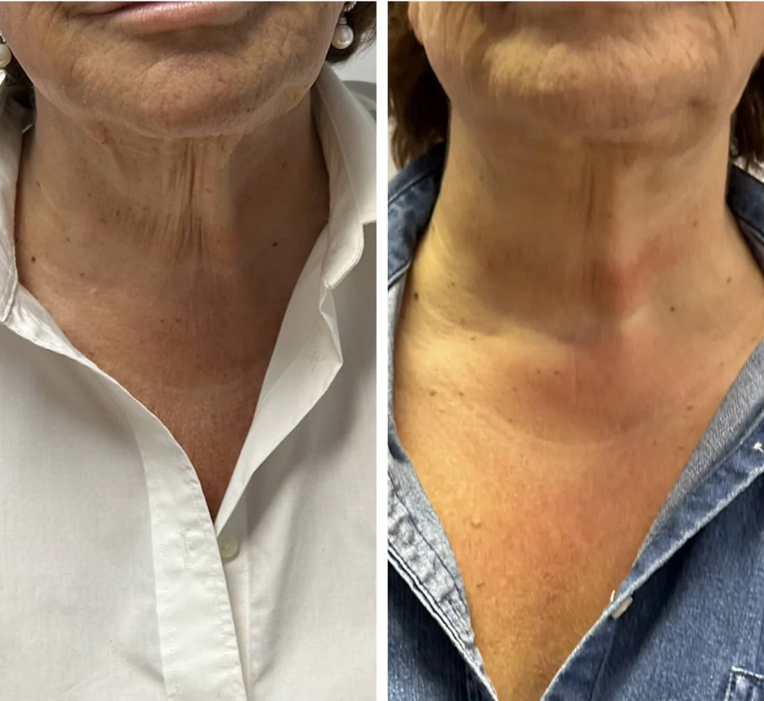 Before and after six CryoFacial sessions on the neck and jawline
