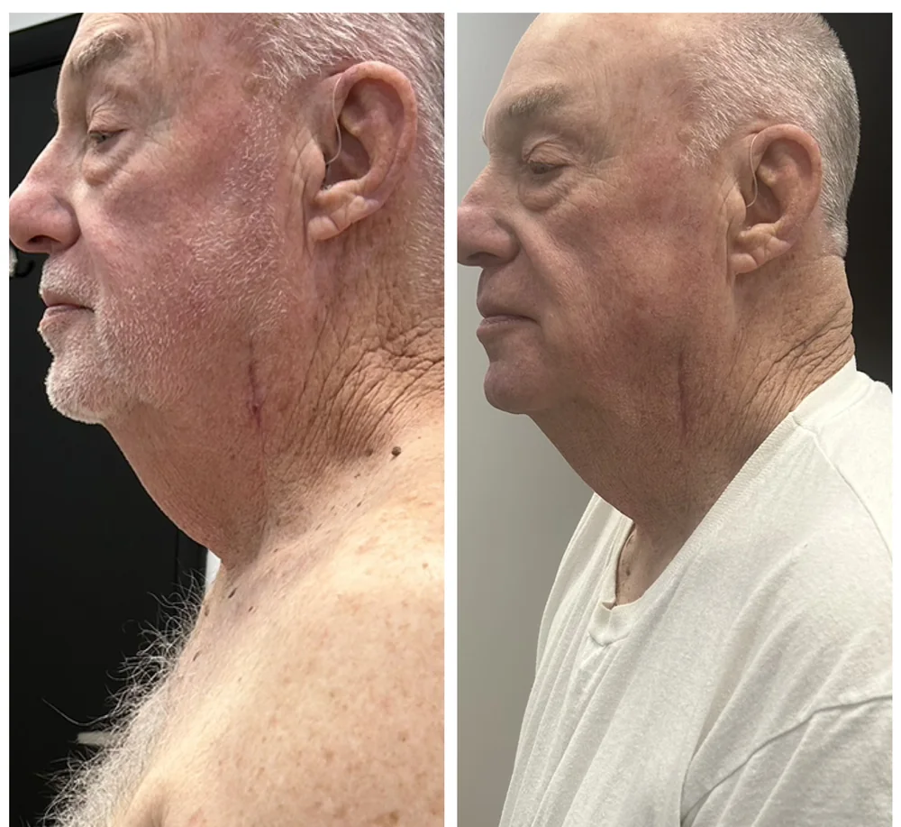 Before and after CryoFacial treatments on the neck and jawline